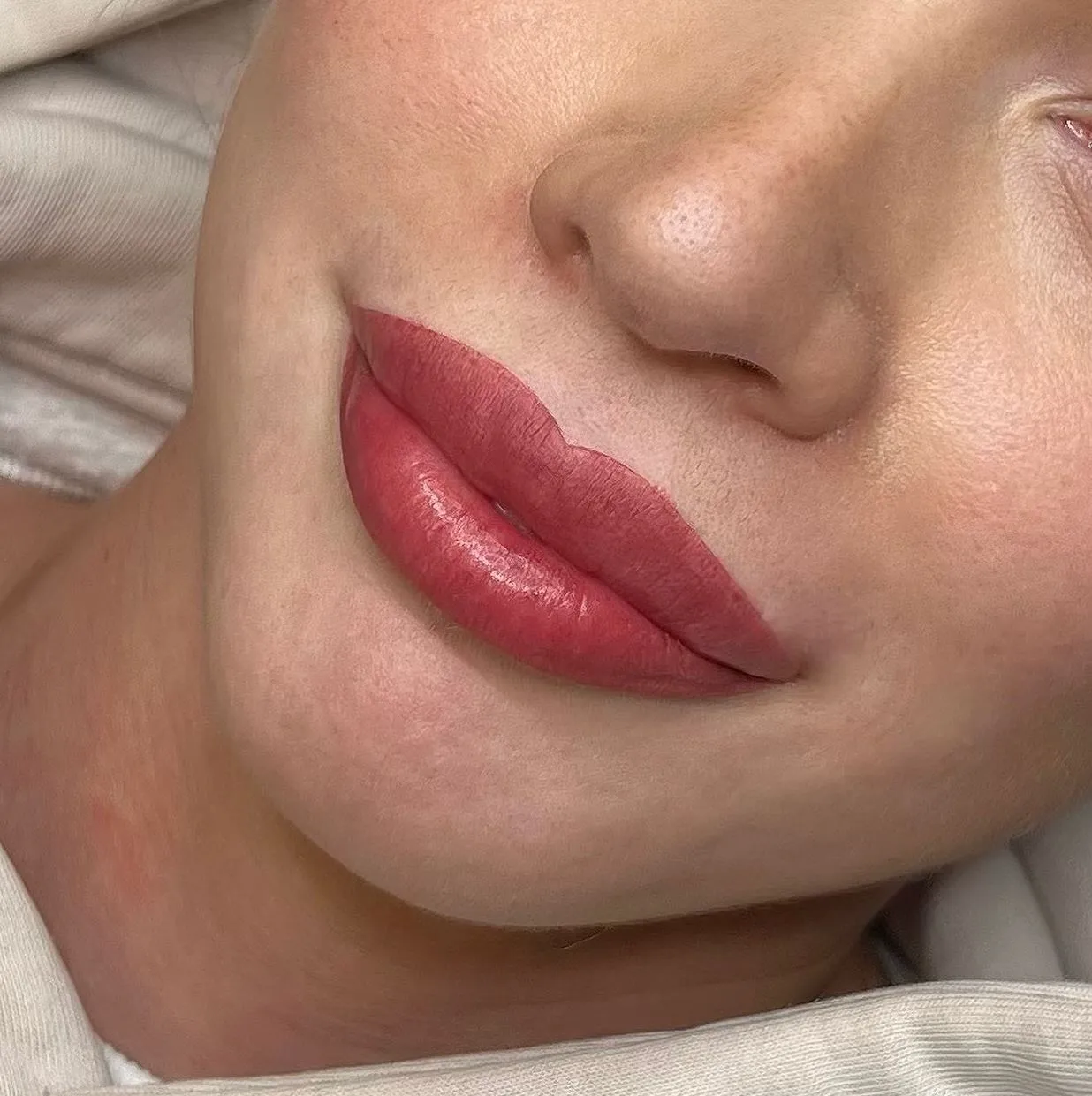 What Are Lip Fillers
